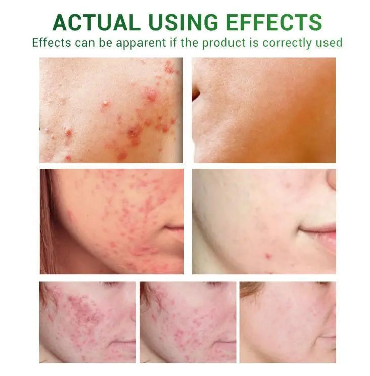 Acne Treatment Serum Facial Repair Oil Louisiana Mart