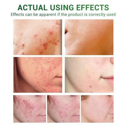 Acne Treatment Serum Facial Repair Oil Louisiana Mart